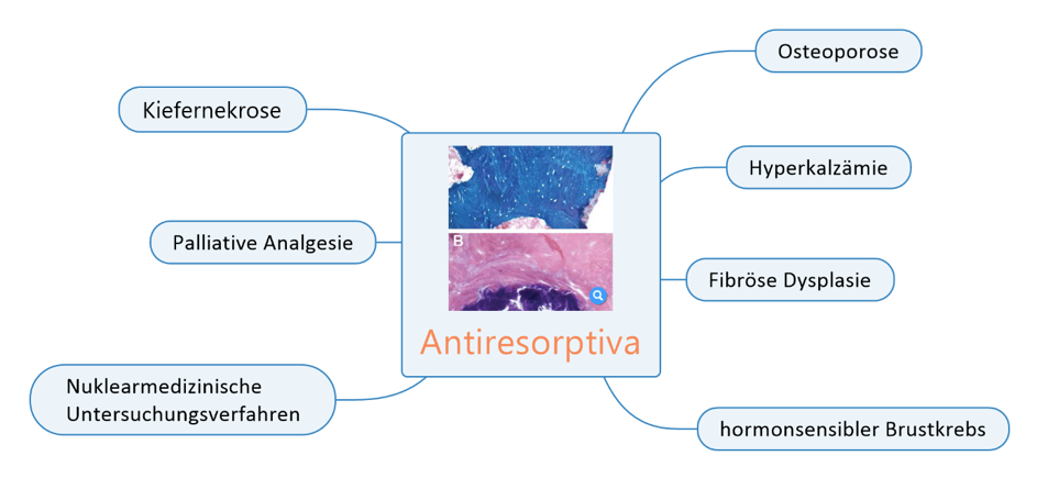 Anwendungsgebiete Antiresorptiva